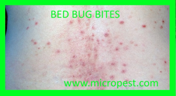 Bed bug bites picture.